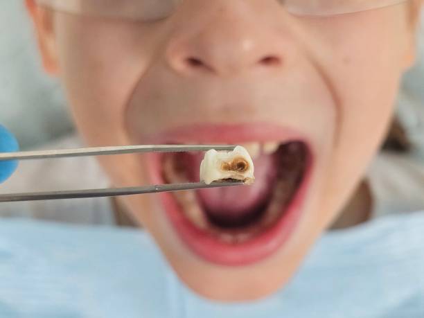 Best Emergency Dental Care for Broken or Chipped Teeth in Selinsgrove, PA